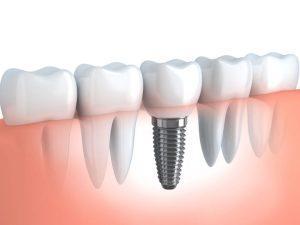 single dental implant