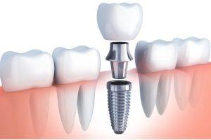 cheap dental implant