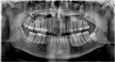 wisdom totth and cyst 32 after treatment 400x215 1