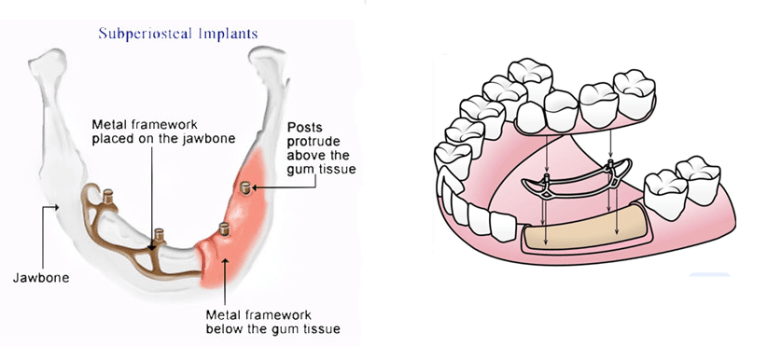 Subperiosteal Implantation: The only implant solution in case of severe ...